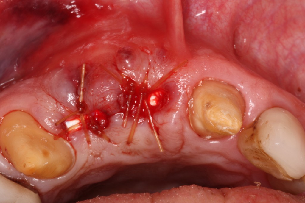 Top View Bone Graft Before Dental Implants Ryan Lanman Dds Msd