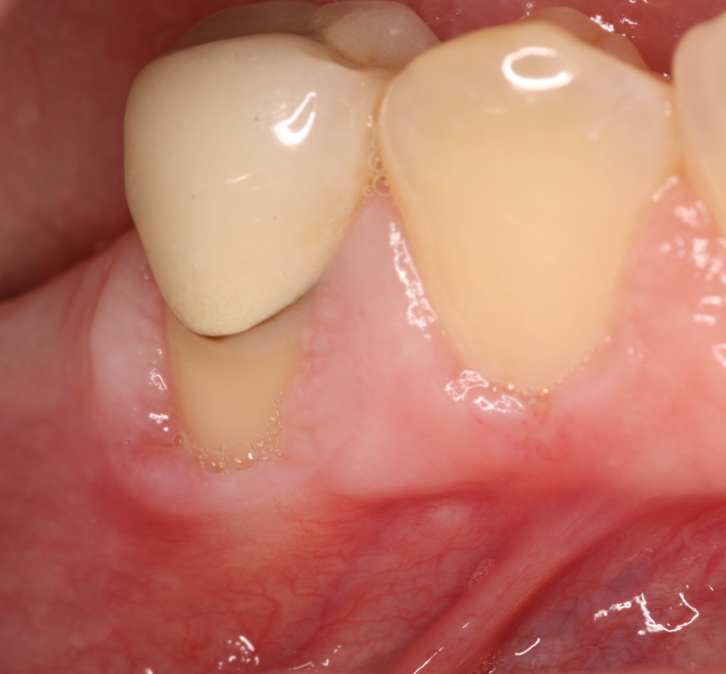 Recession Inflammation Ryan Lanman DDS MSD