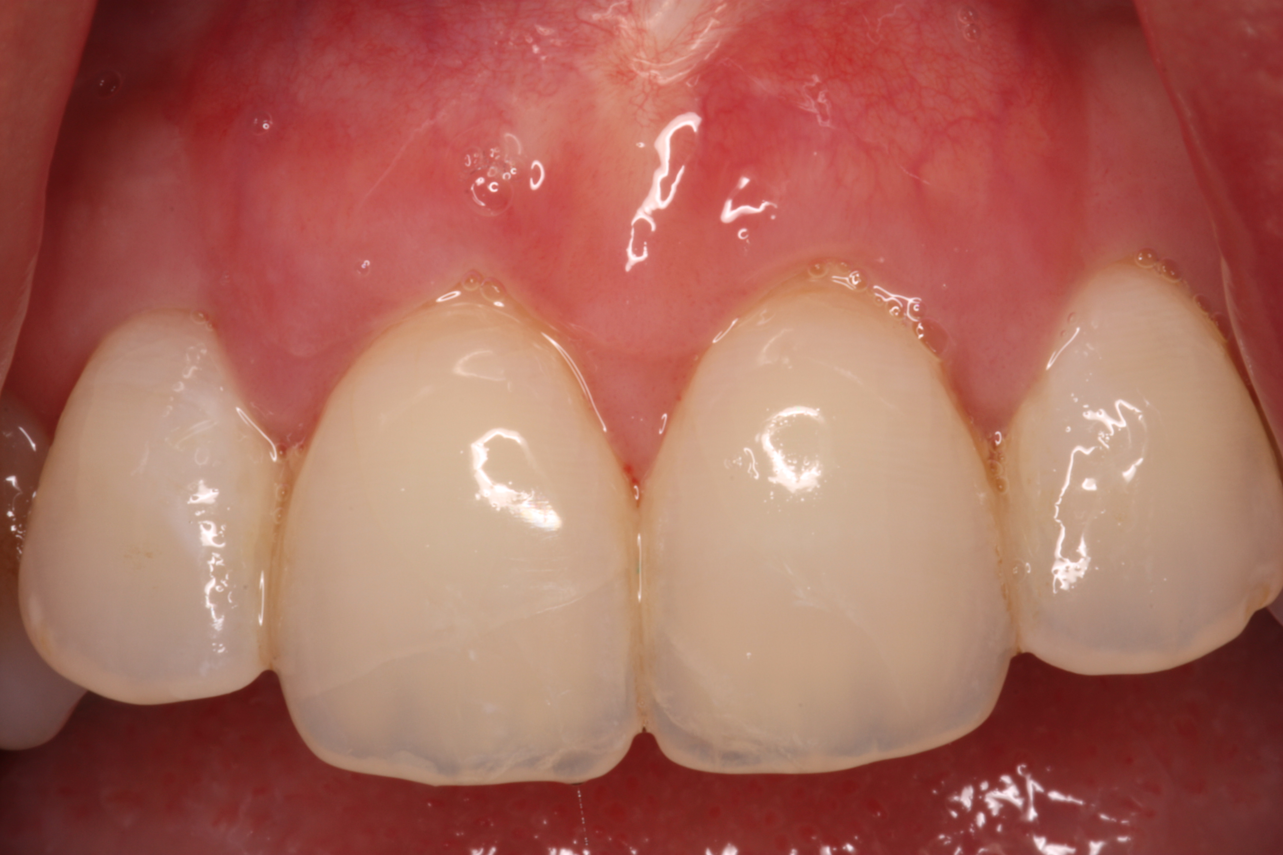 Treatment of Gum Recession - Ryan Lanman DDS, MSD