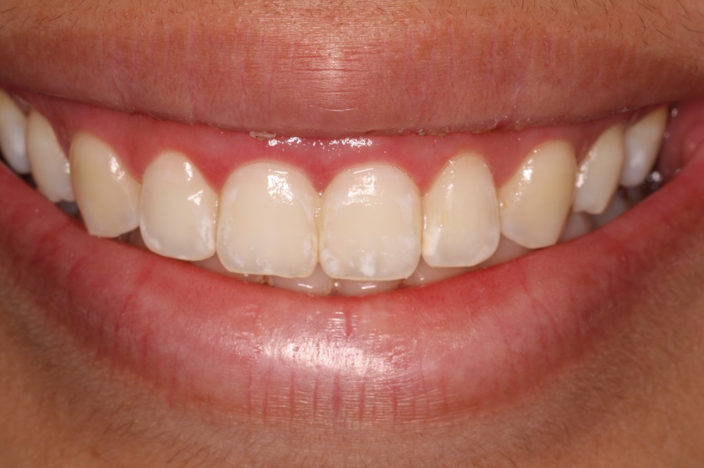 Remove Gummy Smiles in Oklahoma City - Ryan Lanman DDS, MSD