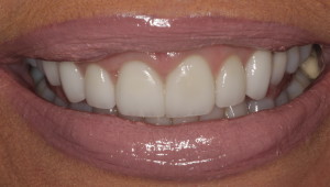 After pic of gummy smile treatment.